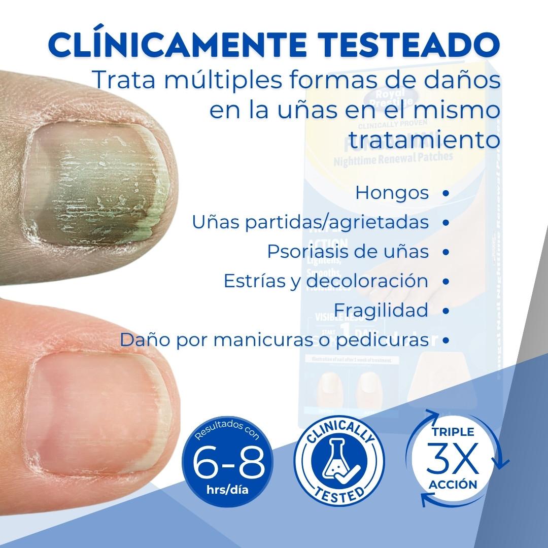 2x1 Parches para Uñas - Elimina Hongos sin esfuerzos (32 parches en total)