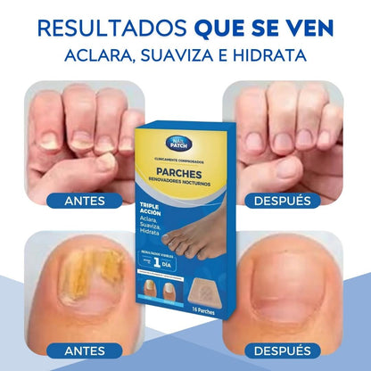 2x1 Parches para Uñas - Elimina Hongos sin esfuerzos (32 parches en total)